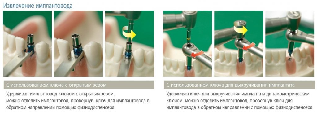 Извлечение имплантовода